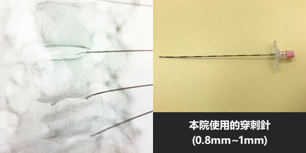 本院使用的穿刺針(0.8mm～1mm)