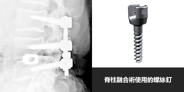 脊柱融合術使用的螺絲釘