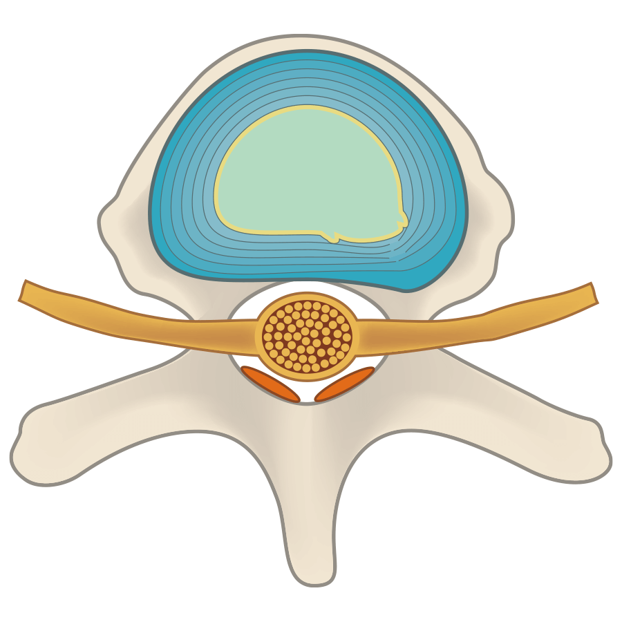 突出來的椎間盤通過減壓回縮，治療後凝膠會成為椎間盤一部分，起到緩衝作用。