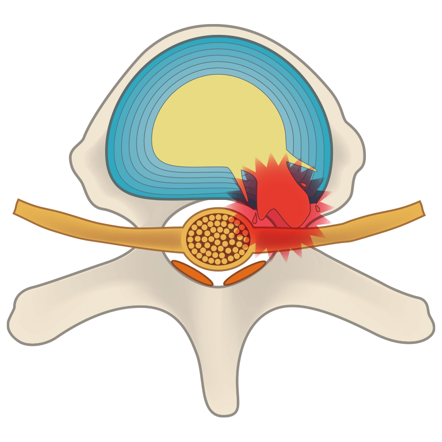 椎間盤突出碰觸神經引發炎症的椎間盤。