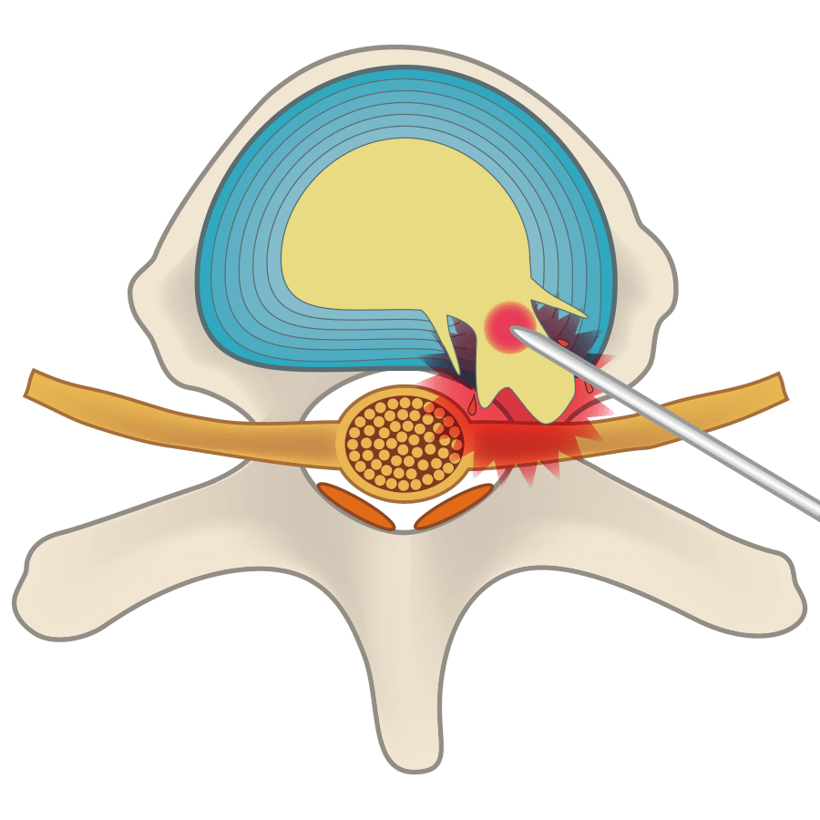 通過激光的熱量使椎間盤中的一部分髓核蒸發，出現空洞，使突出的椎間盤縮回。