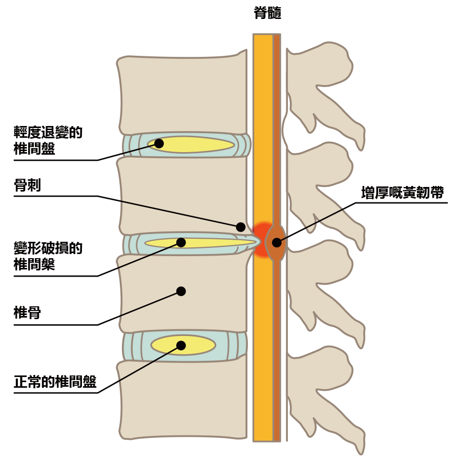 腰椎管狹窄