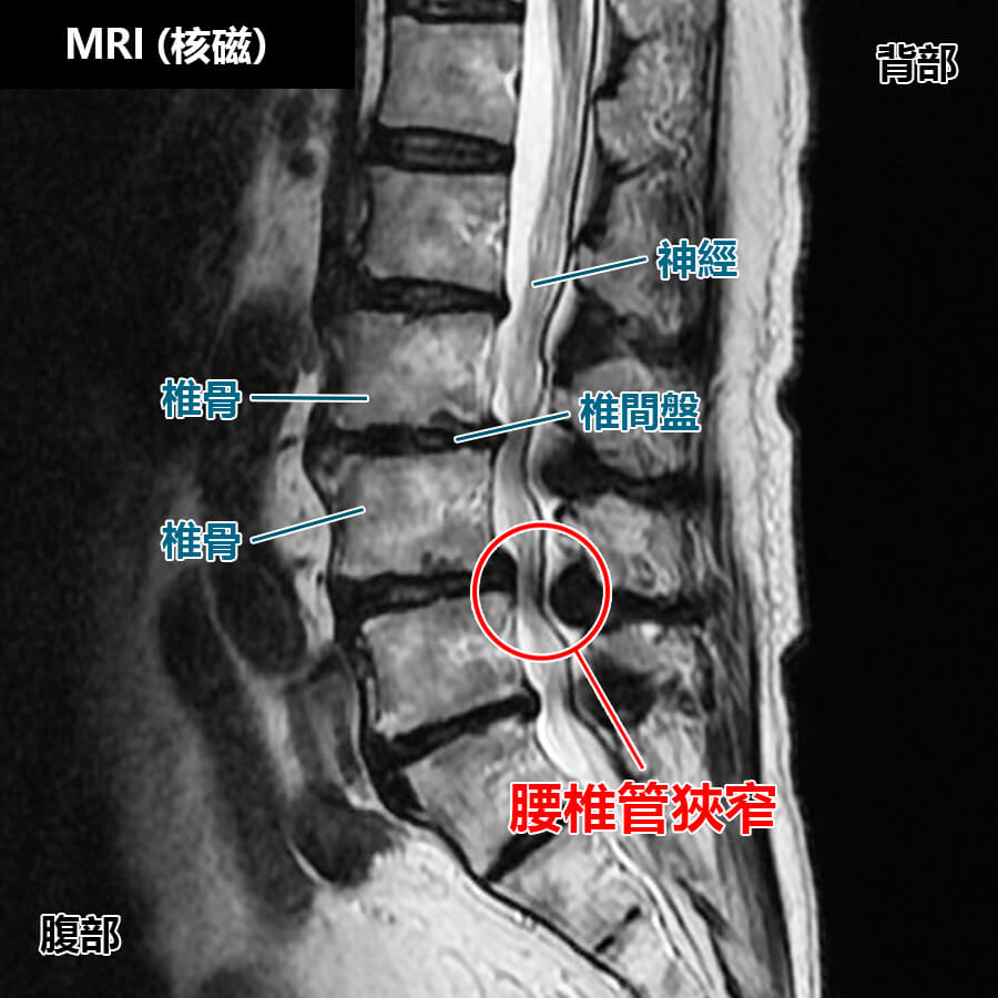 腰椎管狹窄-MRI