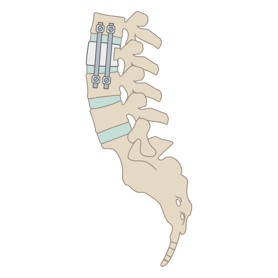 前路腰椎椎間融合術