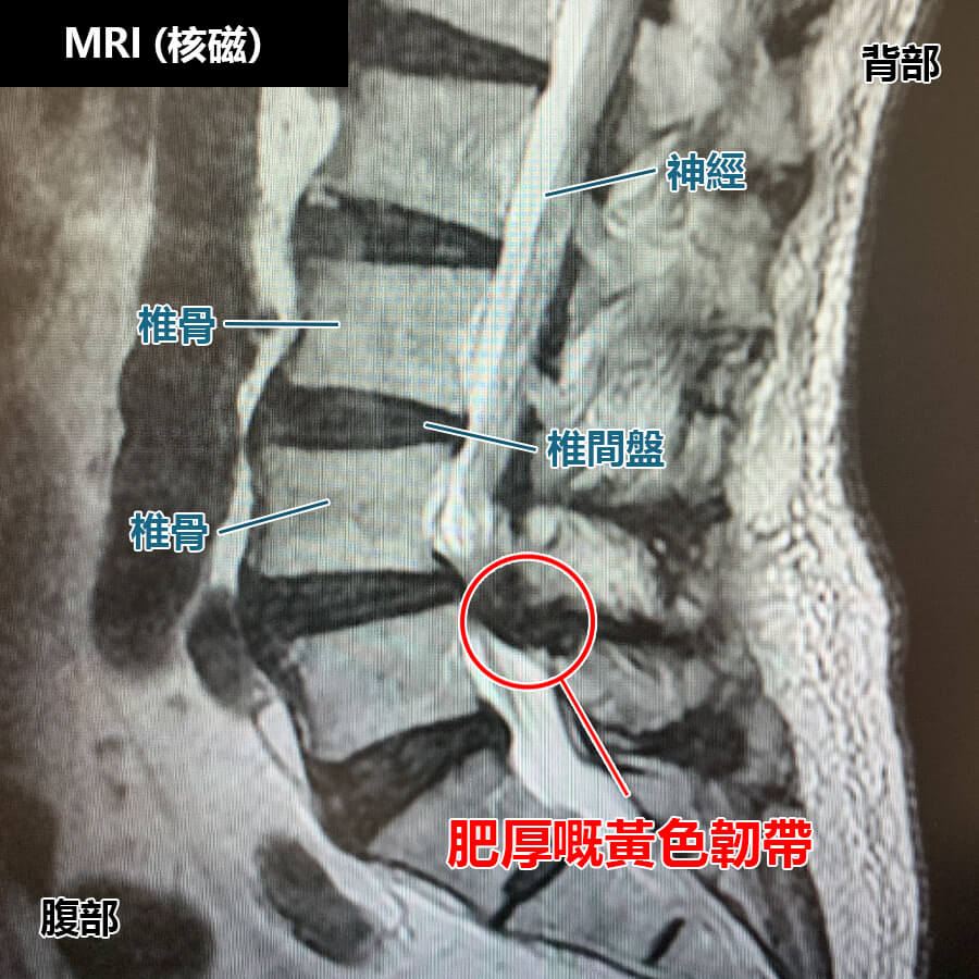 腰椎滑脫症的診斷方法：MRI