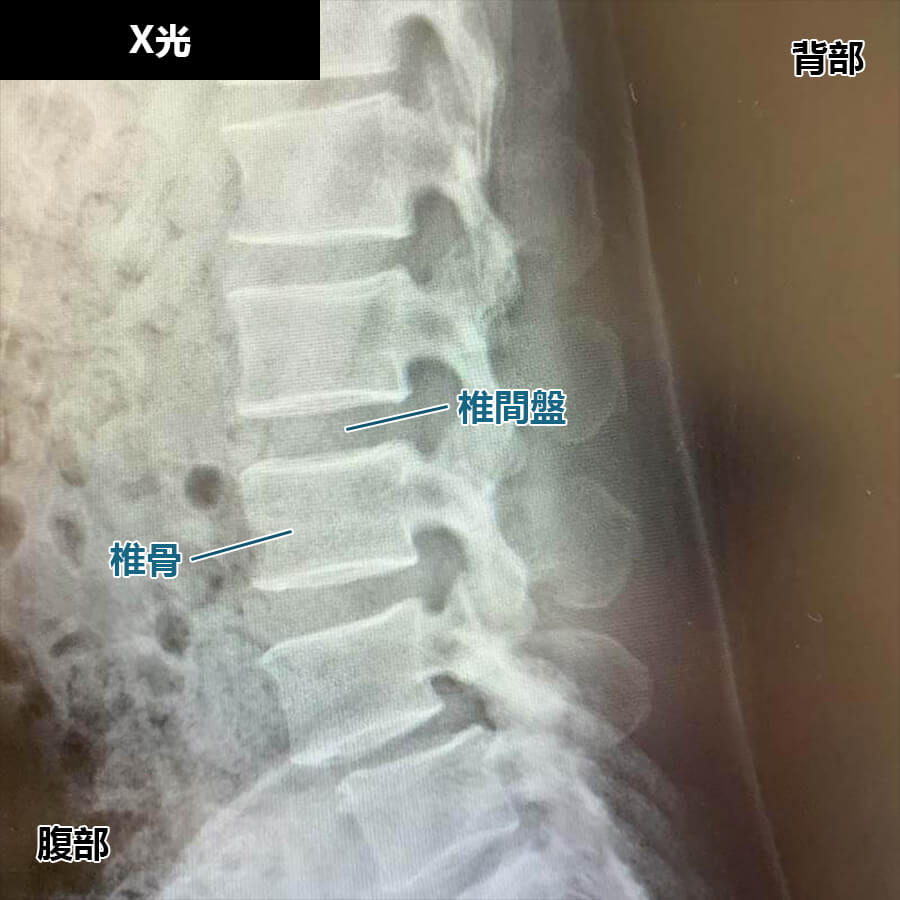 腰椎滑脫症的診斷方法：X光